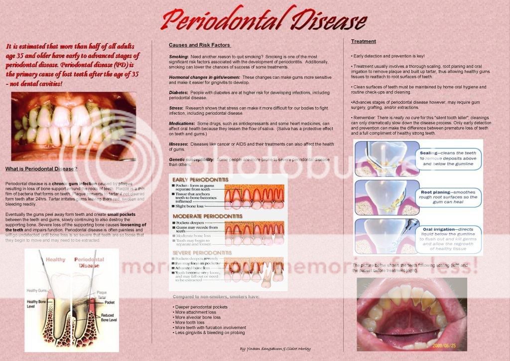 Periodontal Disease Photo by UCLan_Dental Photobucket